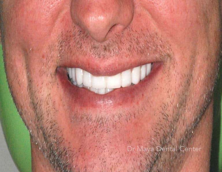 How To Care For Your Lumineers Teeth